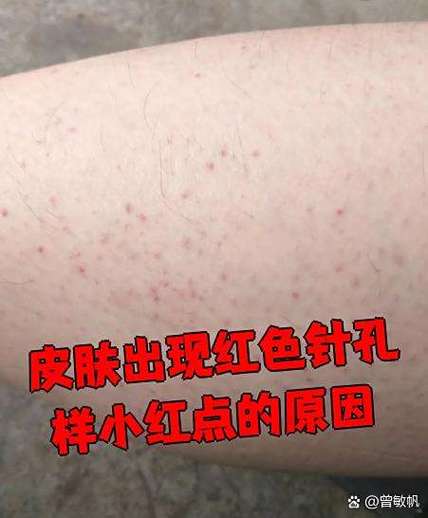 身上有针眼大的小红点是怎么回事缩略图