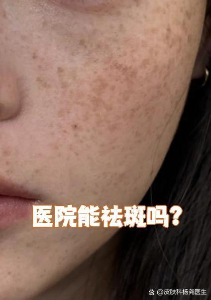 医院皮肤科可以祛斑吗