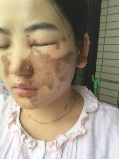 脸上被油烫伤有疤痕怎么去除