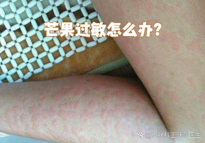 吃芒果皮肤过敏怎么办