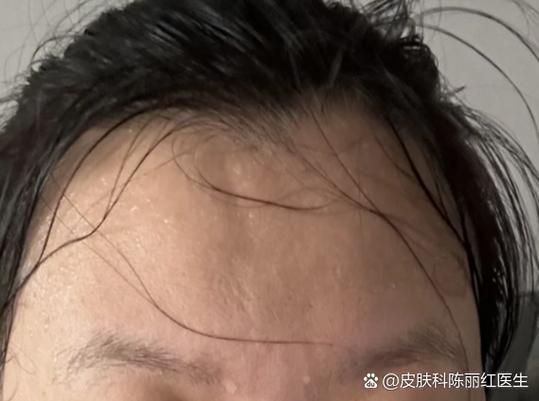 额头凹了一个小坑
