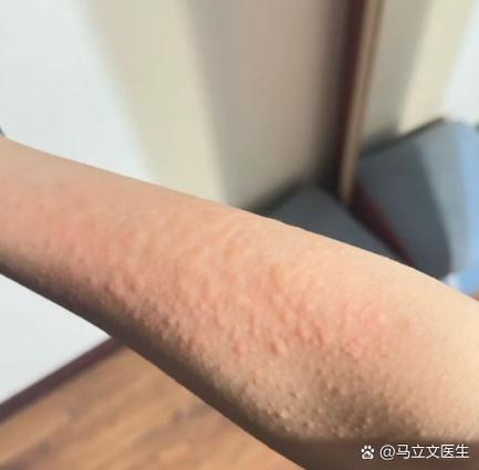 扑尔敏和香蕉敷脸对过敏有效吗?图标