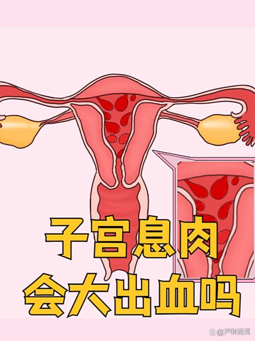 为什么子宫里面会长息肉