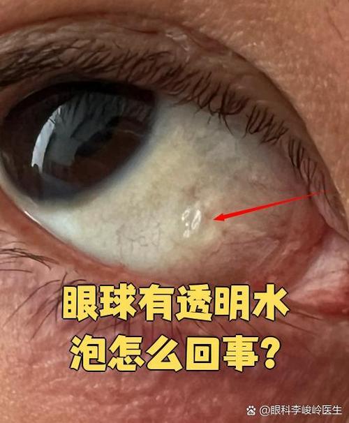 眼睛突然流眼睛水截图