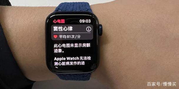 心电图手表有用吗