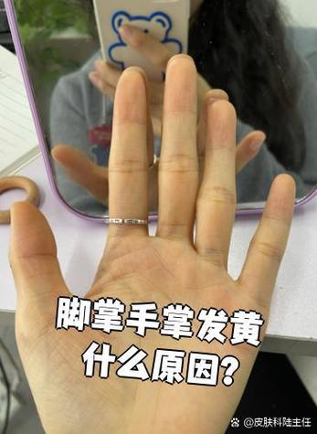 大人手脚发黄是怎么回事儿