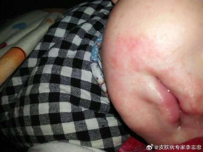 婴儿湿疹破皮了可以擦什么