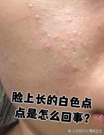 脸上白点是怎么回事缩略图