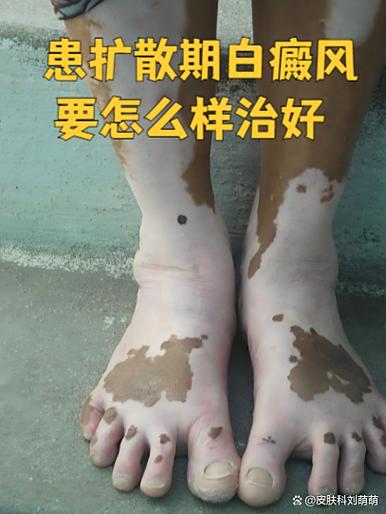 在阳光下皮肤很白是什么皮