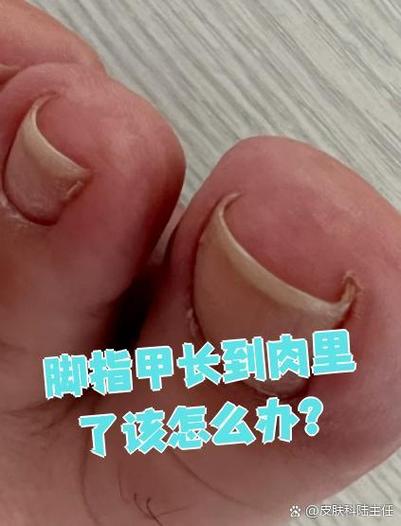 脚指甲长进肉里怎么解决