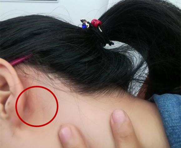 耳朵后面长小米粒疙瘩