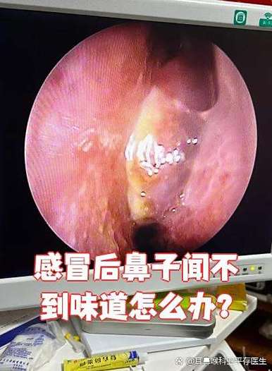 鼻子闻不到味道怎么治