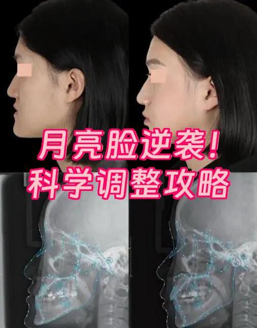 月亮脸怎么改善矫正