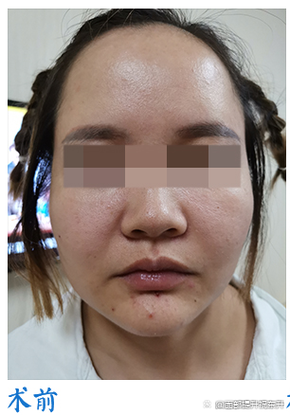 脸的表皮层没有了恢复需要多久