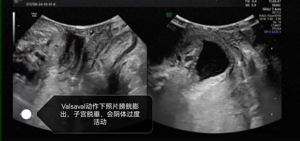 怎么做盆底肌锻炼截图
