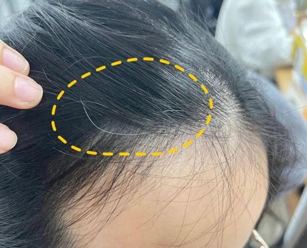 纹头发和植头发哪个好截图