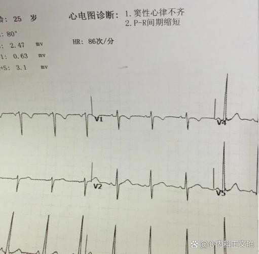 心律不齐的主要原因