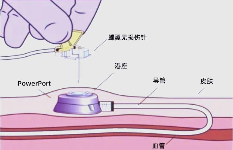 输液港化疗后什么时间取出