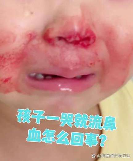 小孩流鼻血有一条浓稠的血条