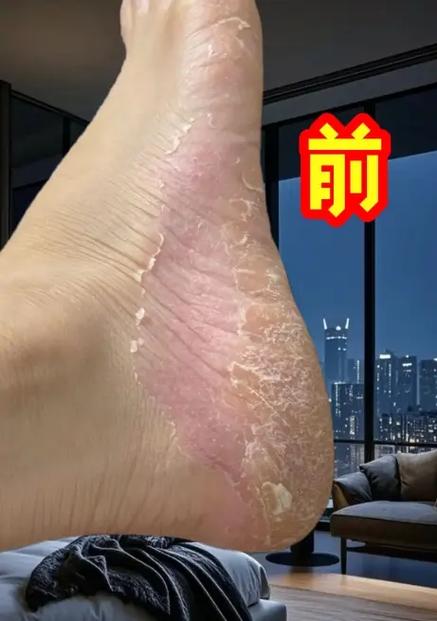 脚裂口偏方三天见效
