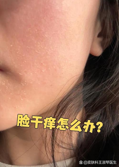 脸上干痒