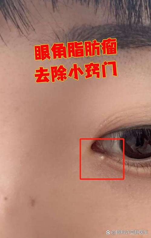 眼睛边上的脂肪瘤怎么去除