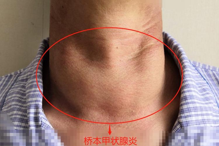 桥本氏甲状腺炎并有甲状腺结节