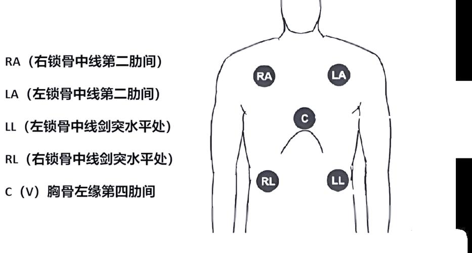 心电监护仪怎么看图解