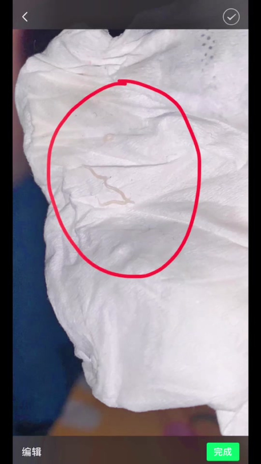 寄生虫从腿部钻入肛门里寄生