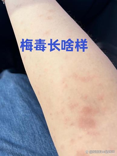 正常人皮疹图片游戏截图