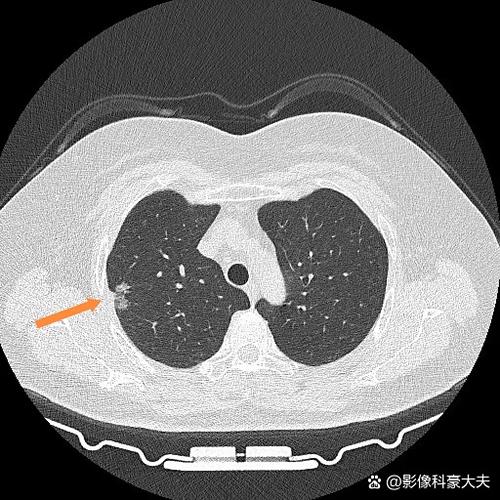 肺结节吃葡萄好吗