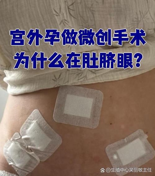 宫外孕保守好还是微创