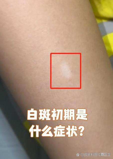 轻度白斑症状图片