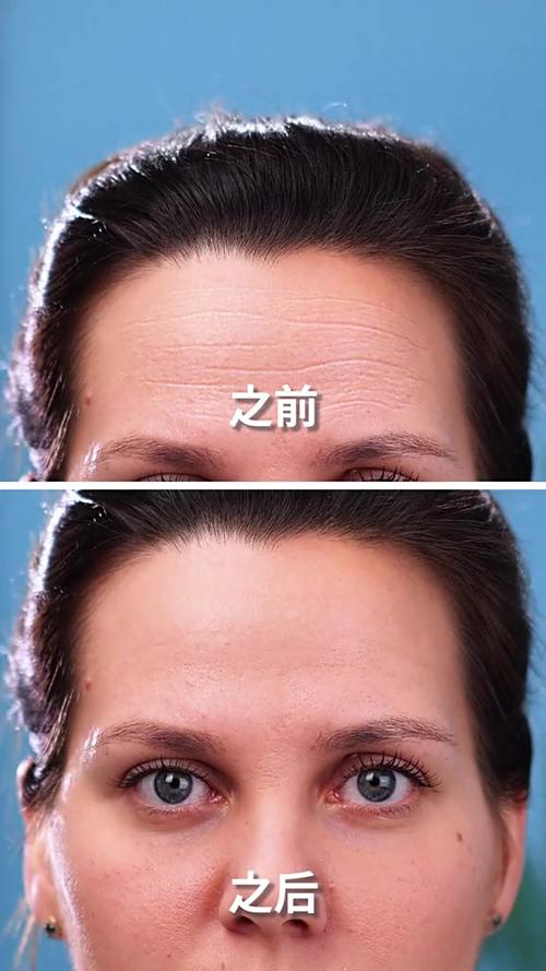 消除抬头纹最简单方法