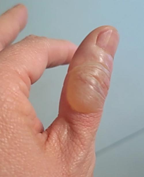 手被烫起白色泡了怎么处理方法