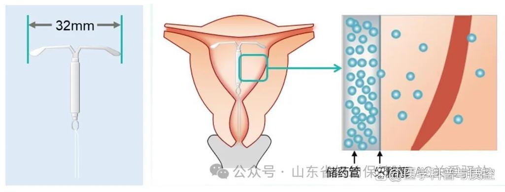 带曼月乐环的副作用