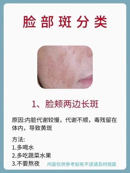 脸上长斑是什么原因引起的