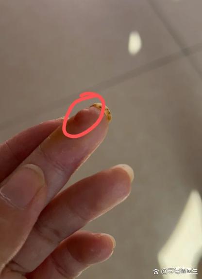 手指上有一道类似疤痕的凸起