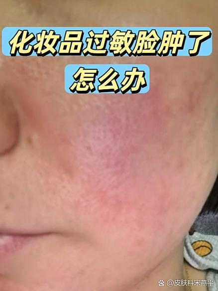 什么过敏会导致脸肿眼睛肿