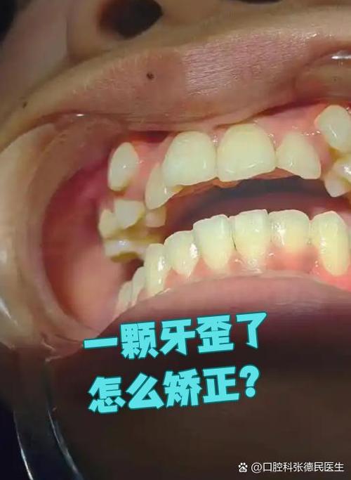 后槽牙歪了可以矫正么图标