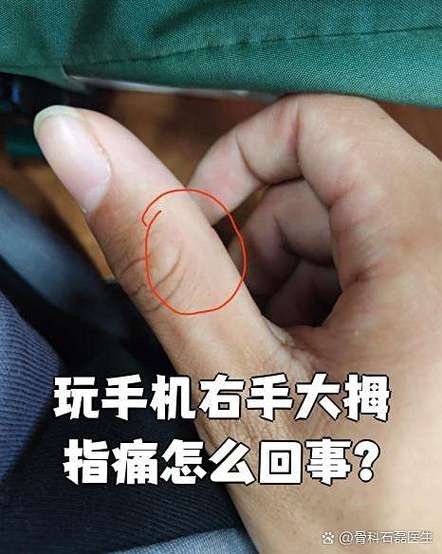 为什么打游戏打久了大拇指痛
