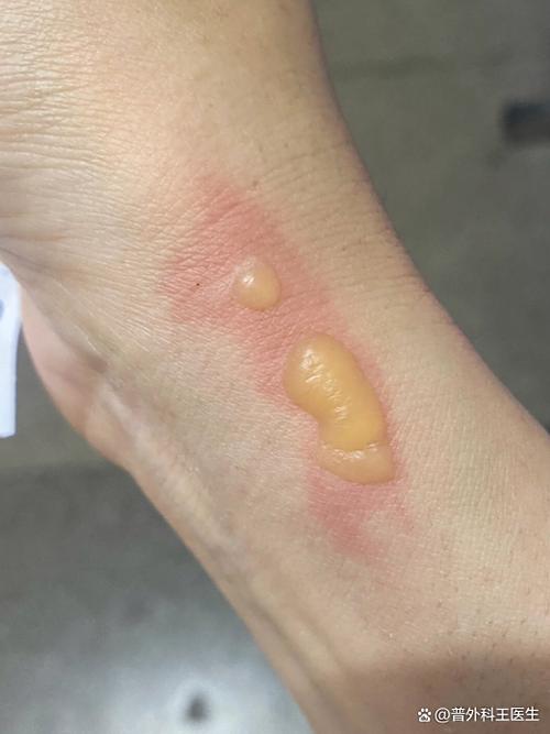 如何让水泡快速消除