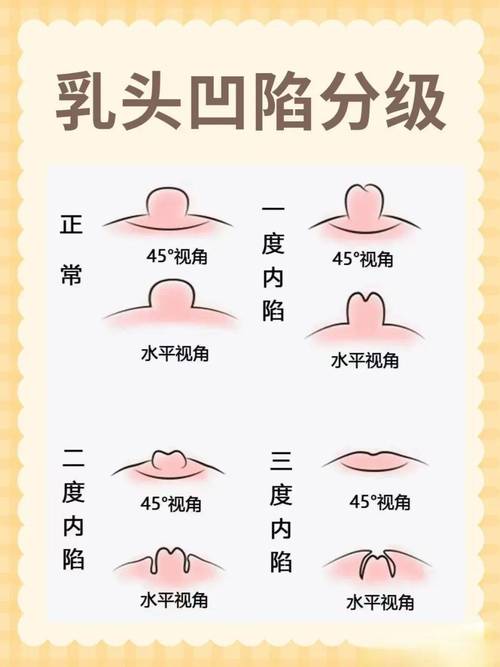 乳头内陷特殊治疗by