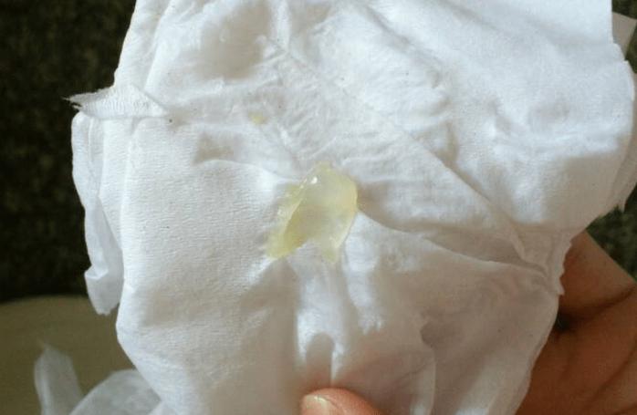 女生小便后擦出透明果冻状分泌物