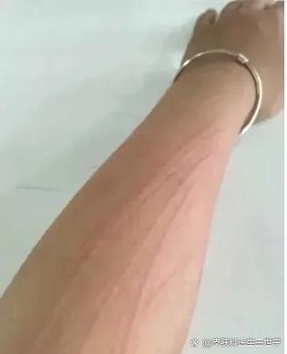 圆珠笔写在皮肤上怎么去除