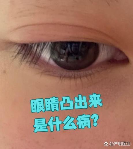眼睛胀痛感觉眼球都要突出来一样