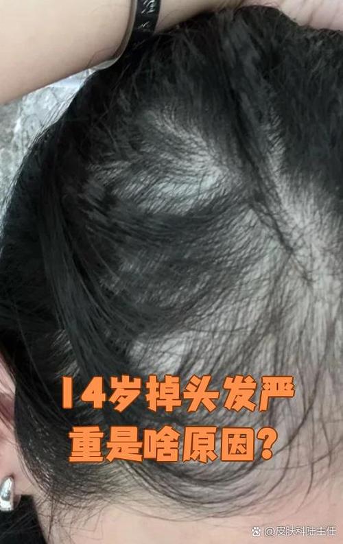 有季节性脱发吗