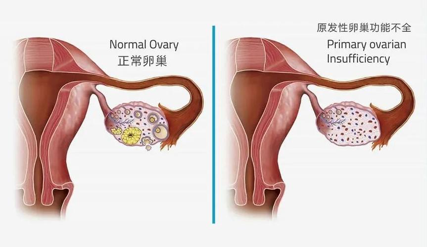 妇科诊断poi是什么意思