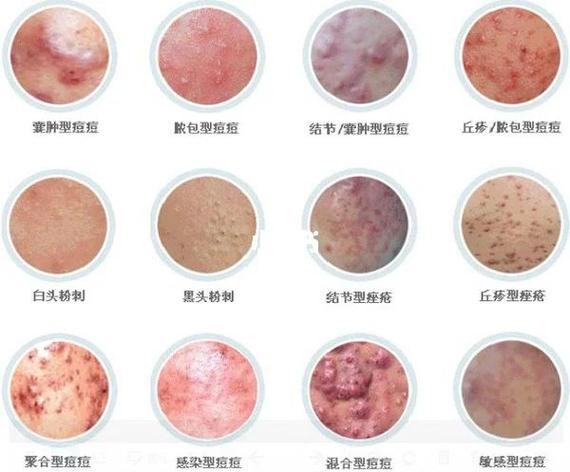 青春痘怎么消除最有效方法