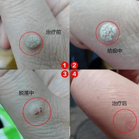 皮肤上长的疣如何治疗